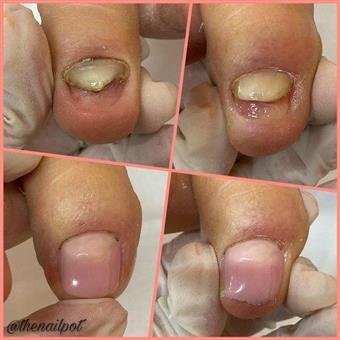 services_nanoflex_nail_restoration